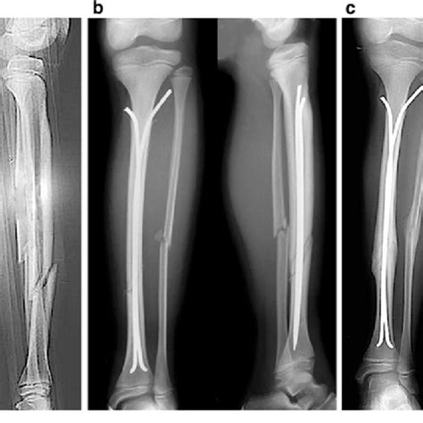 Acceptable Alignment Of A Paediatric Diaphyseal Tibial Fracture