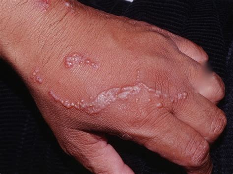 Allergic Contact Dermatitis Poison Ivy