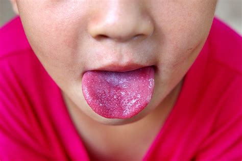 Scarlet Fever Symptoms Causes And Treatment