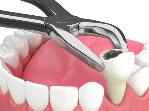 Tooth Extractions The Dentist Of Siouxland Restorative Dental Care