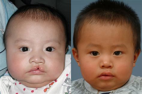 Cleft Lip Surgery After Care Primary Cleft Lip And Nasal Reconstruction