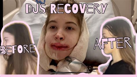 My Double Jaw Surgery Experience Recovery Youtube