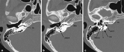 Normal Inner Ear Anatomy Demonstrated On Axial Ct Images Of The Right