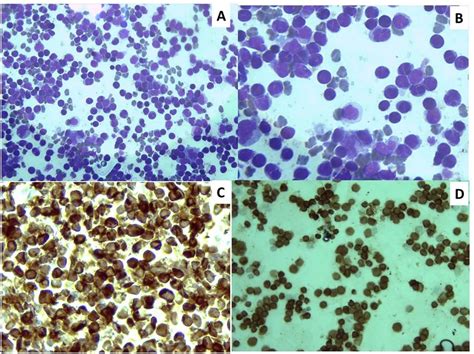 Precursor T Lymphoblastic Lymphoma Cytology Blastic Cells With Scant
