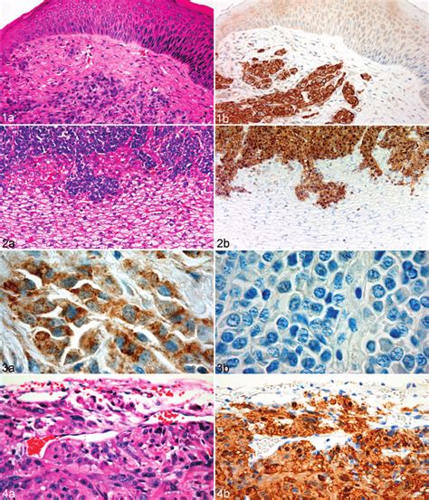 The disease is characterised by large tumours, mostly on the face and mouth, which often spread to internal organs. Primary DFTD tumor; Tasmanian devil. Figure 1a. DFTD ...