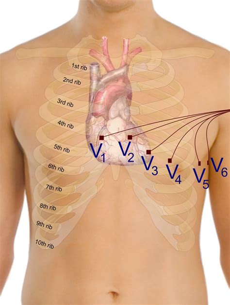 Lead Ecg Placement Color Coded