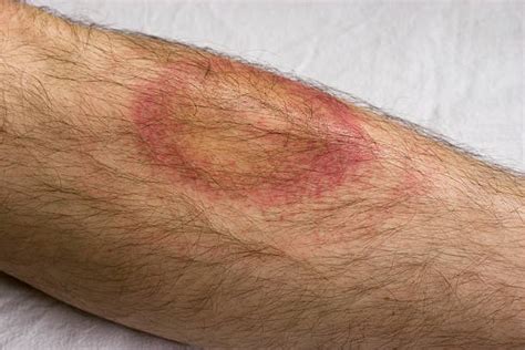 6200 Erythema Migrans Stock Photos Pictures And Royalty Free Images