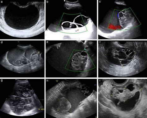 Solid Ovarian Mass Ultrasound