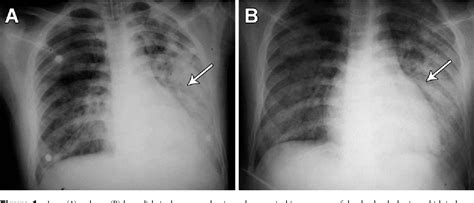 Figure 1 From A Fatal Outcome Due To Pulmonary Hemorrhage Following