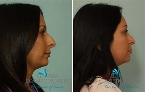 How Much Does A Nose Job Cost El Paso Rhinoplasty El Paso Cosmetic Surgery