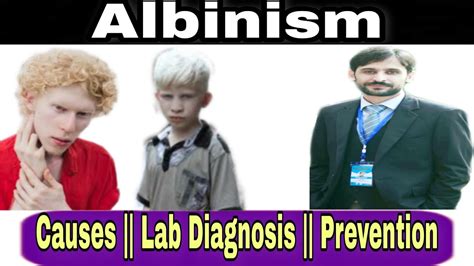 Albinism Causes Lab Diagnosis Prevention Youtube
