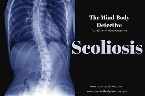 A Non Surgical Approach To Scoliosis