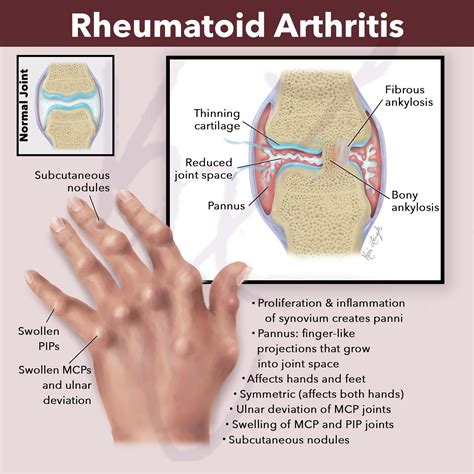 Excellent Illustration Of Rheumatoid Arthritis By Keri Leigh Biomedical Creations Llc