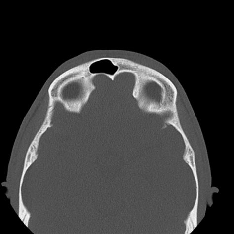 The ethmoid bone is one of the 8 bones of the cranium. Nasal bone fracture | Radiology Case | Radiopaedia.org
