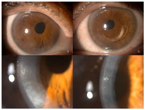 Ijms Free Full Text Posterior Polymorphous Corneal Dystrophy In A