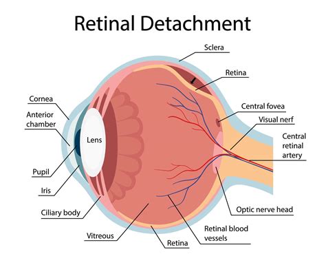 Retinal Detachment Vector Diagram Anatomical Diagram Vector Cartoon