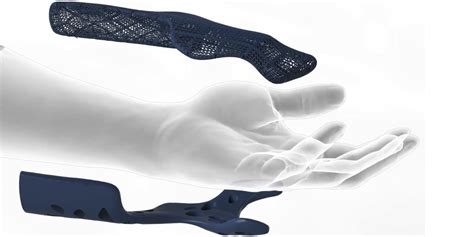Healx Unveils 3d Printed Customized Orthopedic Wrist Braces 3dprint