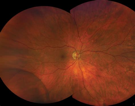 Can We Pre Empt Damage From Retinal Detachment