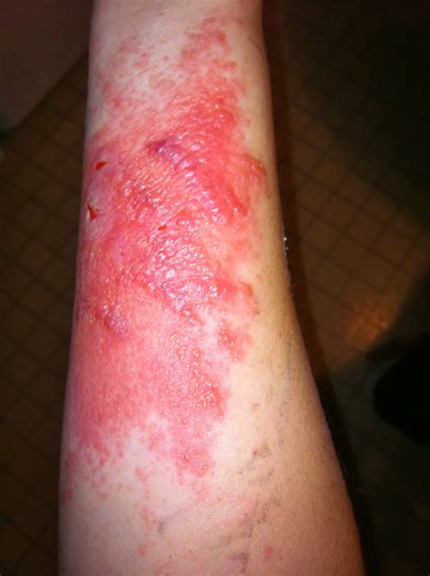 What To Do If Poison Ivy Rash Keeps Spreading