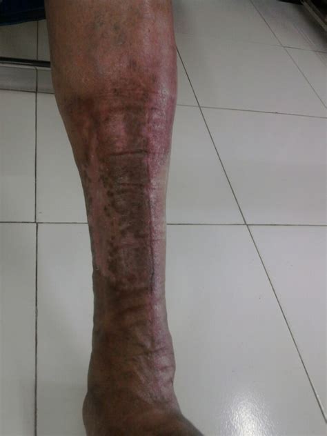 Cellulitis Of The Leg Diabetic Foot Clinic