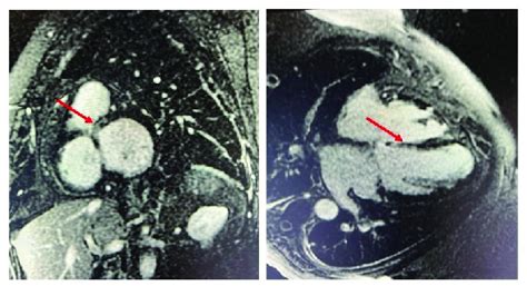 Cardiac Mri Showing Late Gadolinium Enhancement In The Mesocardium Of