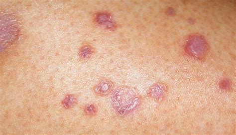 Diabetic Skin Rash Images Symptoms And Pictures