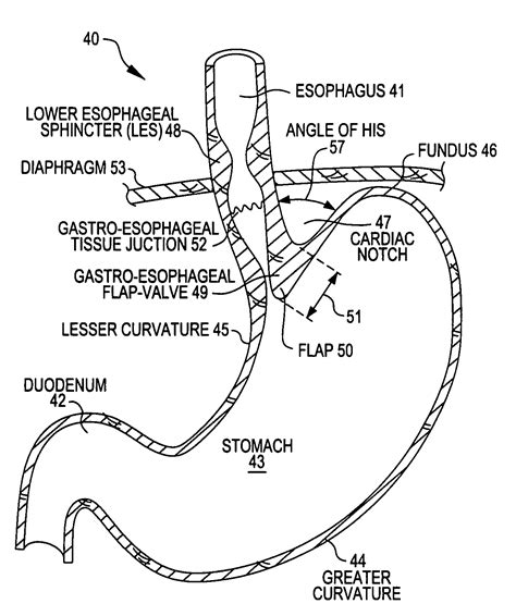 Patent Us20080281337 Transoral Endoscopic Gastroesophageal Flap Valve