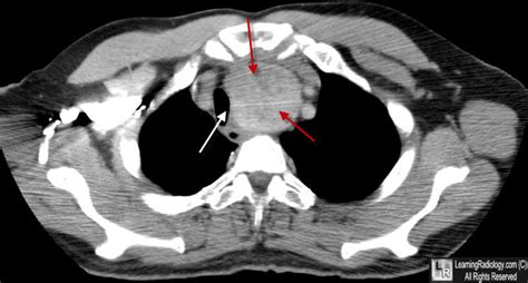 Learning Radiology Substernal Thyroid Goiter