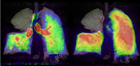 Volume Rendered Petct Images Showing Large Areas Of Aerated Lung In