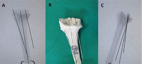 The Malunion Of Distal Radius Fracture Corrective Osteotomy Through