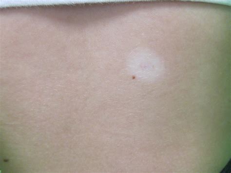 A Teenager With A Changing Mole On Her Back Consultant360