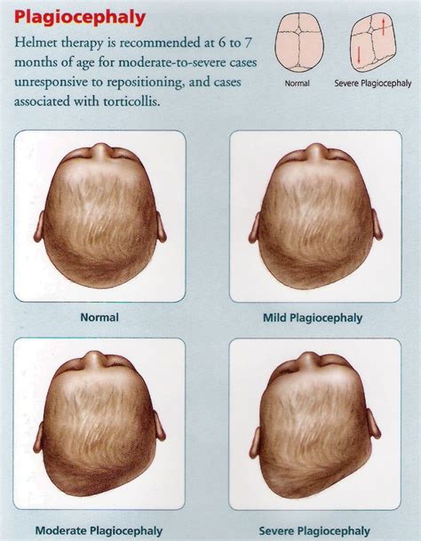 Flat Head Syndrome In Babies Flat Head Baby Flat Head Baby Or