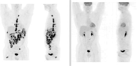 Lymphoma Action Scans X Ray Ct Pet And Mri