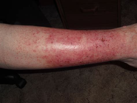I Would Like To Ask Another Question And Send Pic Of A Rash