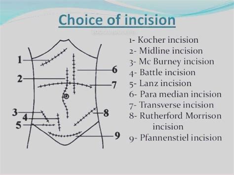 Doctordconline Different Types Of Incision Incision Surgery