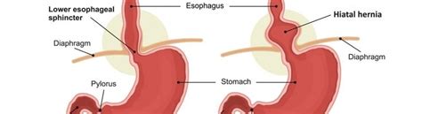 A Complete Overview Of Hiatal Hernia Bharat Dasani MD Gastroenterologist