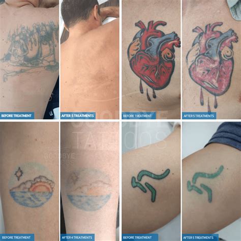 What Tattoo Colours Are The Hardest To Remove Goodbye Tattoos