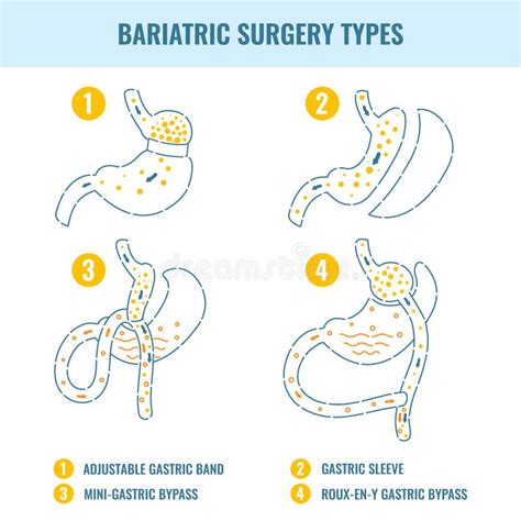 Bariatric Surgery Weight Loss Procedure Types Infographics Stock Vector