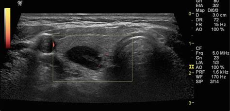 Ultrasound And Fna In Parathyroid Disease Fundamentals Of Appearance