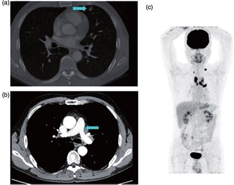 Imaging In The Clinical Diagnosis A Chest Computed Tomography Ct