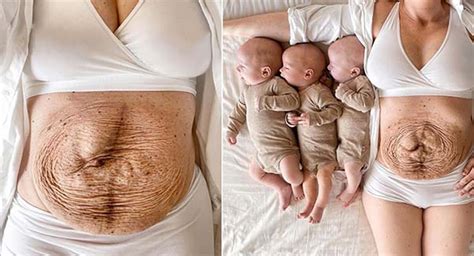 The Mother Of Triplets Shared Her Belly During Pregnancy And Postpartum