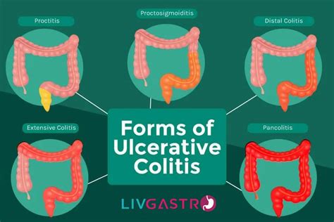 Deciphering Ulcerative Colitis Causes Symptoms Diagnosis And Treatment