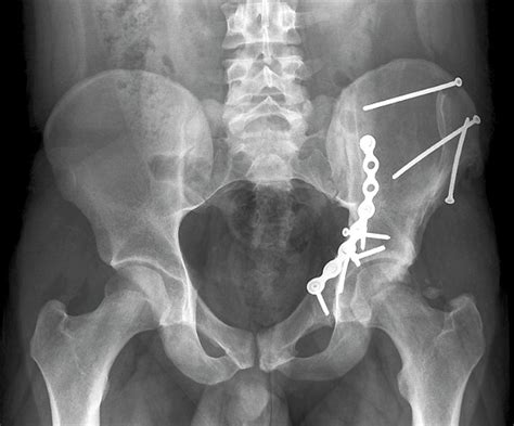 Pinned Hip Fractures Photograph By Zephyrscience Photo Library Fine