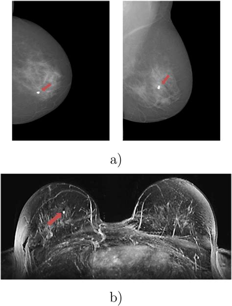 Lesion In A Cc And Mlo Mammograms And B The Maximum Intensity