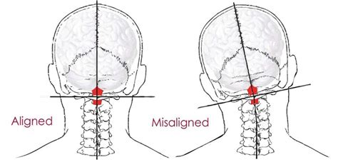 Services The Head And Spine Pain Center Upper Cervical Specific And