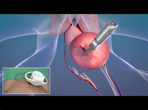 Mkt A Magnetic Surgery In A Prostatectomy Procedure Prostate Removal Youtube