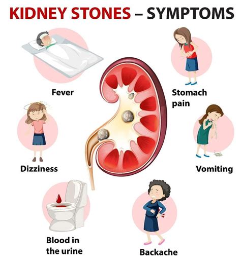 Kidney Stones Symptoms Cartoon Style Infographic Kidney Stones Symptoms