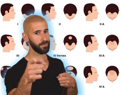 Suffering or worried about hair loss? The Norwood Scale: Hair Loss Stages | Scalp Micro USA