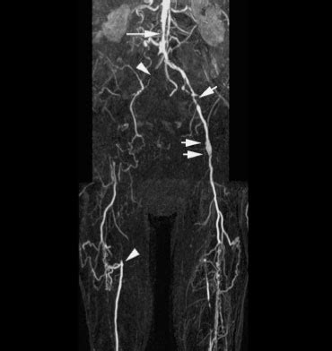 6.13 ct angiography of the right upper limb: The Radiology Assistant : Periferal MRA - Contrast-enhanced