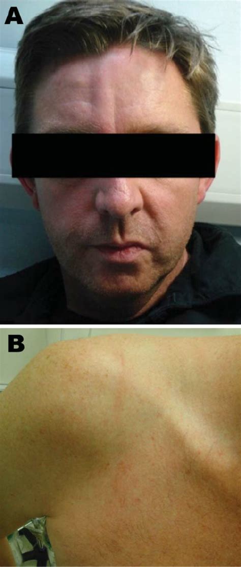 Cutaneous Larva Migrans On The Forehead A And Shoulder B Of A Male